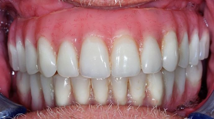 Teeth In A Day: Case 17 - After