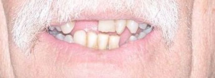 Teeth In A Day Case 17 - Before