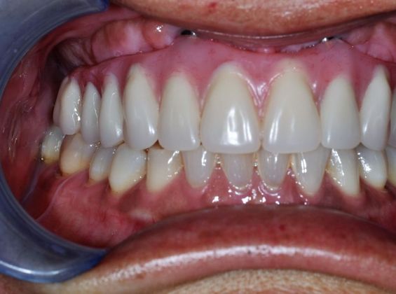 Teeth In A Day: Case 18 - After