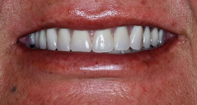 Teeth In A Day Case 18 - After