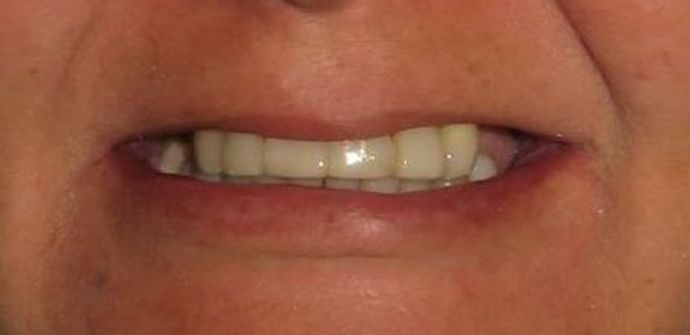 Teeth In A Day Case 18 - Before