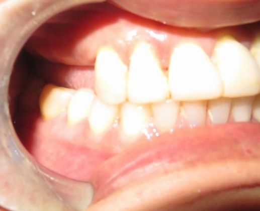 Teeth In A Day: Case 18 - Before