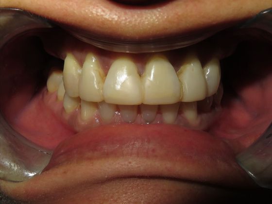 Teeth In A Day: Case 18 - Before