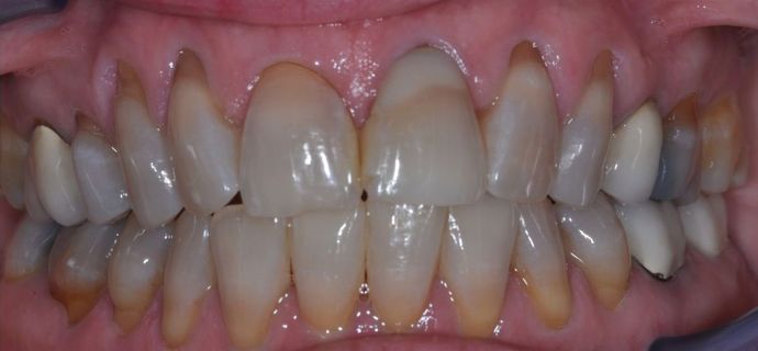 Veneers Case 11 - Before