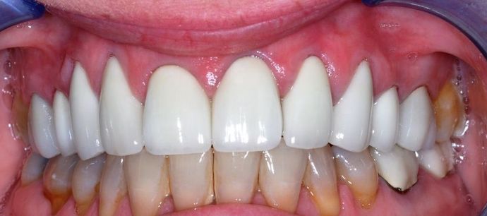 Veneers Case 11 - After