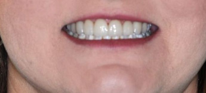 Dental Crowns Case 17 - After