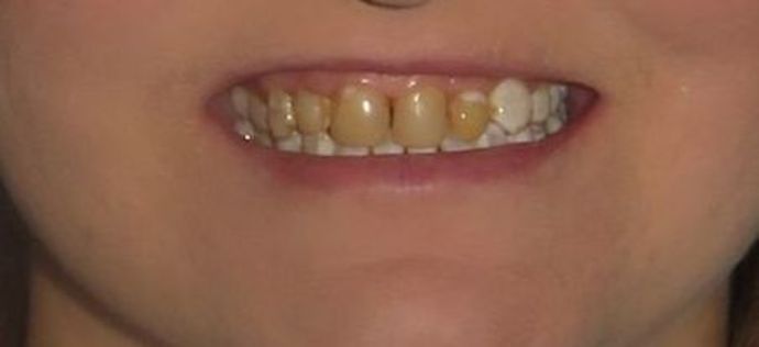 Dental Crowns Case 17 - Before