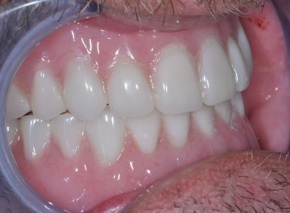 Dentures: Case 1 - Upper and Lower Arch