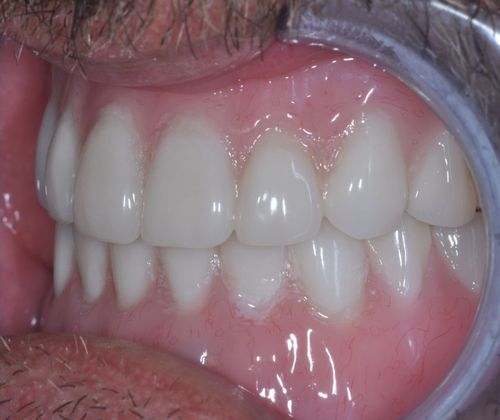 Dentures: Case 1 - After
