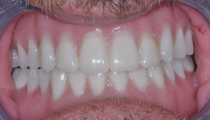 Dentures: Case 1 - After
