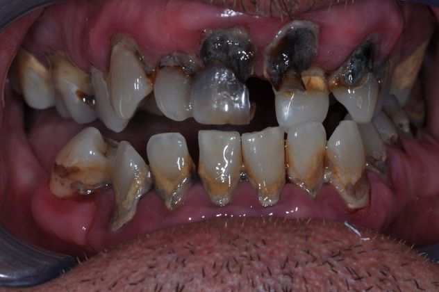 Dentures: Case 1 - Before