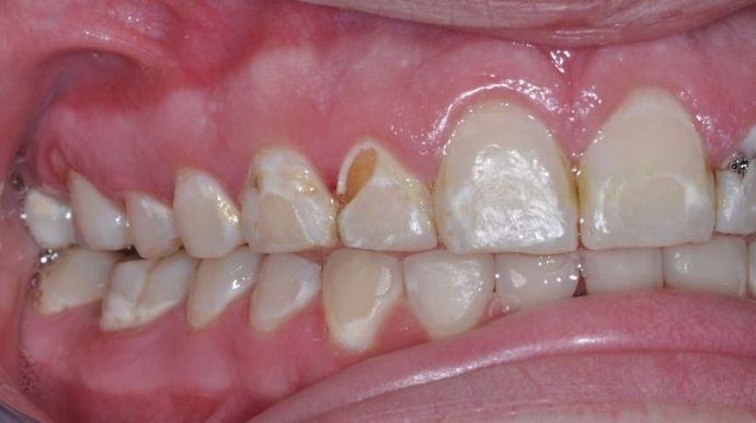 Dental Crowns: Case 2 - Before