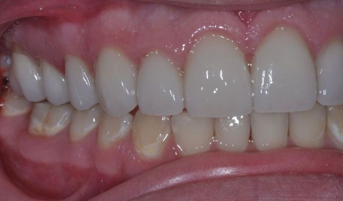 Dental Crowns: Case 2 - After