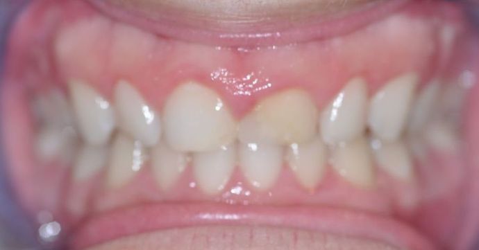 Gum Lift: Case 4 - Before