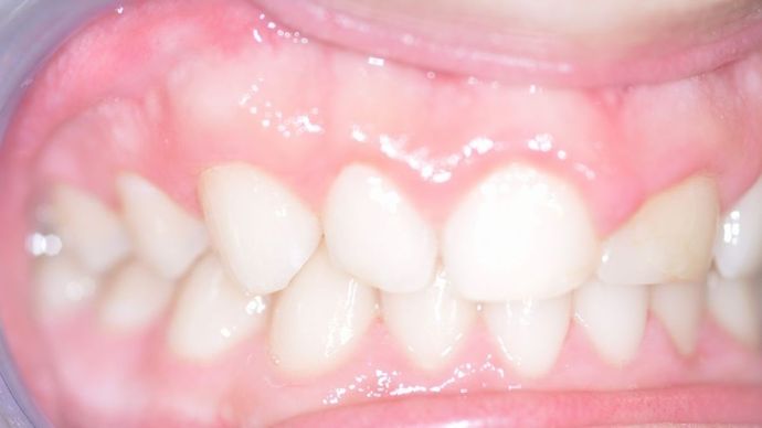 Gum Lift: Case 4 - Before