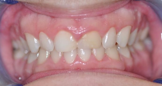 Gum Lift: Case 4 - Before