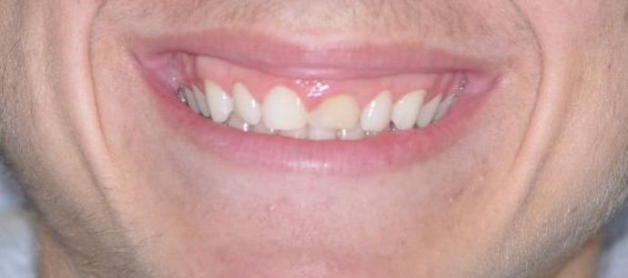 Gum Lift Case 4 - Before