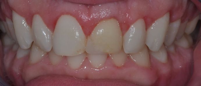 Gum Lift: Case 4 - 2 Weeks After