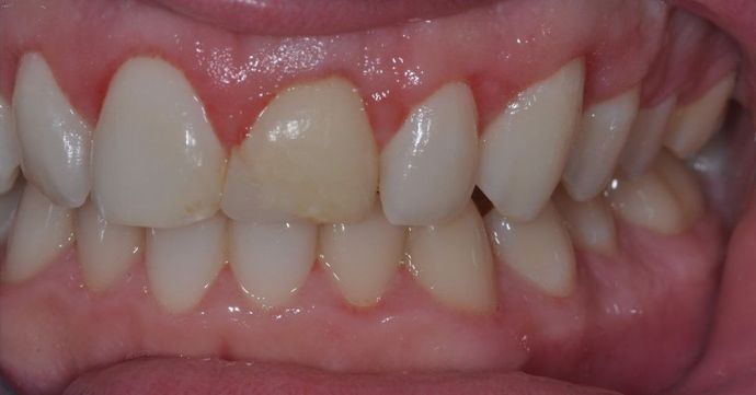 Gum Lift: Case 4 - After