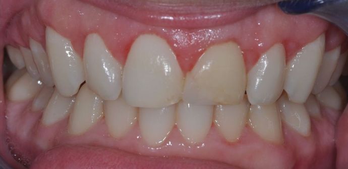 Gum Lift: Case 4 - After