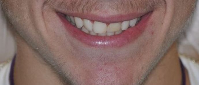 Gum Lift Case 4 - After