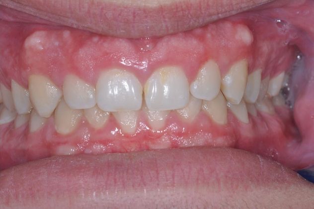 Gum Lift: Case 5 - Before
