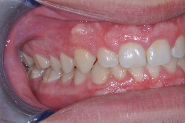 Gum Lift: Case 5 - Before