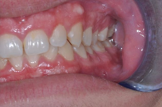 Gum Lift: Case 5 - Before