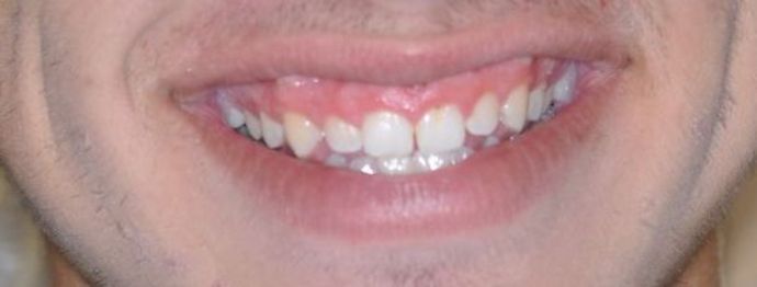 Gum Lift Case 5 - Before