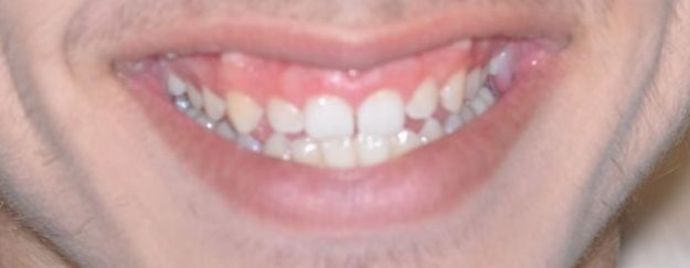 Gum Lift Case 5 - After