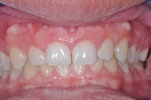 Gum Lift: Case 5 - After