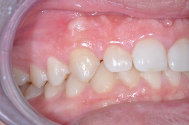 Gum Lift: Case 5 - After