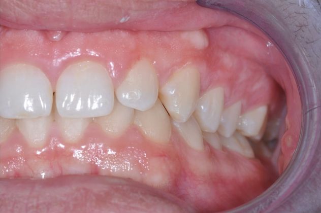 Gum Lift: Case 5 - After