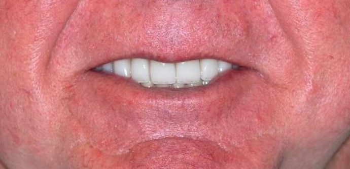 Dental Crowns Case 18 - After