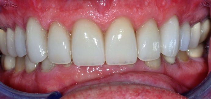 Dental Crowns: Case 18 - After