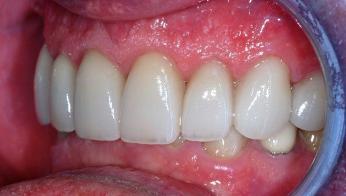 Dental Crowns: Case 18 - After