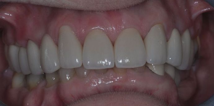 Dental Crowns Case 19 - After