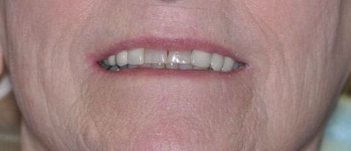 Dental Crowns: Case 19 - Before