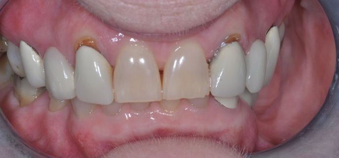 Dental Crowns Case 19 - Before