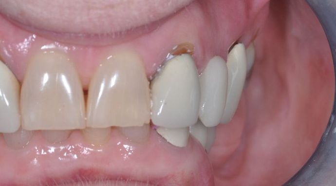 Dental Crowns: Case 19 - After