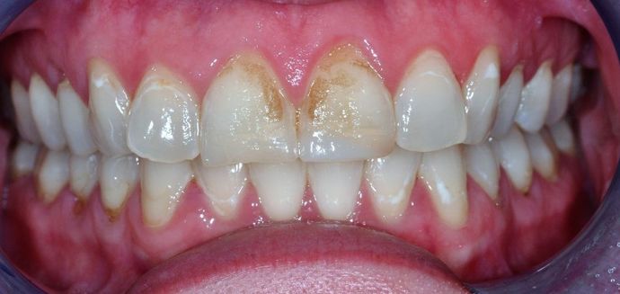 Dental Crowns Case 20 - Before