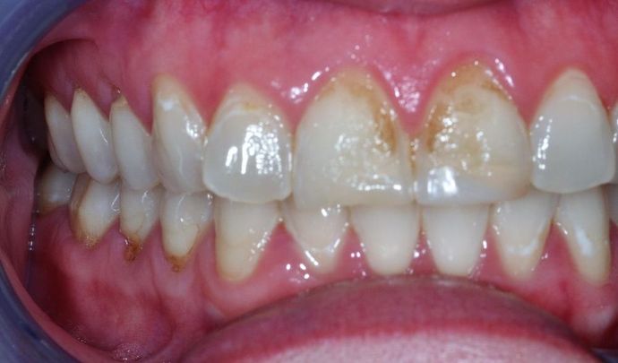 Dental Crowns: Case 20 - Before