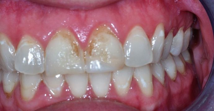 Dental Crowns: Case 20 - Before