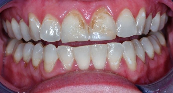 Dental Crowns: Case 20 - Before