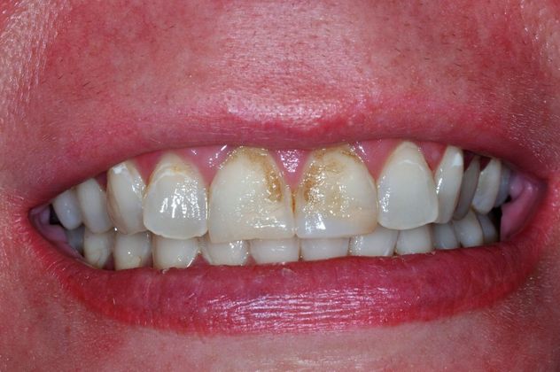 Dental Crowns: Case 20 - Before