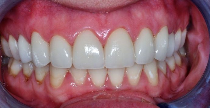 Dental Crowns Case 20 - After