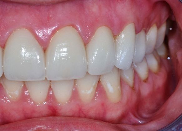 Dental Crowns: Case 20 - After
