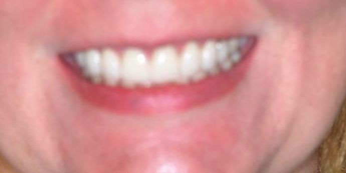 Dental Crowns: Case 20 - After