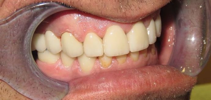 Dental Crowns: Case 21 - Before