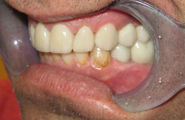 Dental Crowns: Case 21 - After